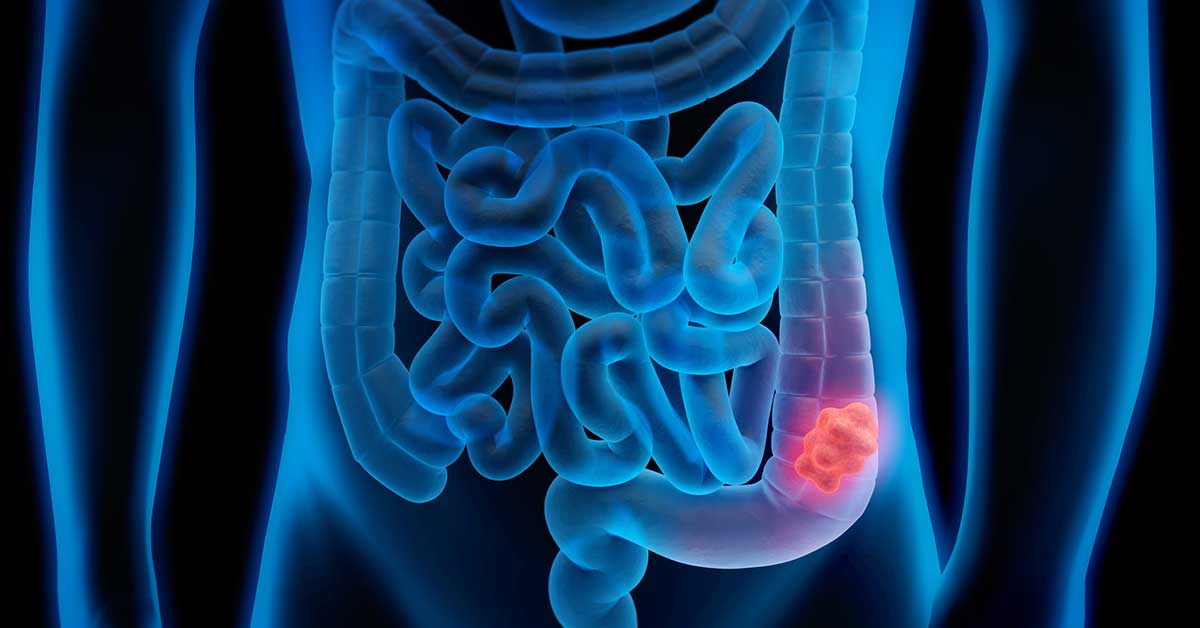 3d illustration of colon cancer