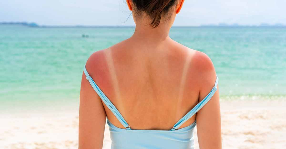 woman at the beach with a sunburn